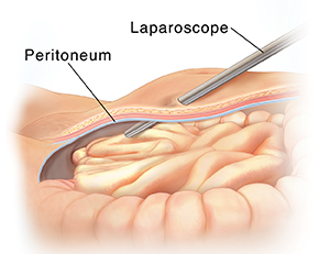 Cross section side view of lower abdomen showing laparoscope entering body through peritoneum.