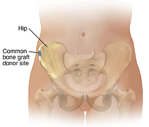Female lower abdomen and pelvic bones, showing a common bone graft side on top edge of hip bone.