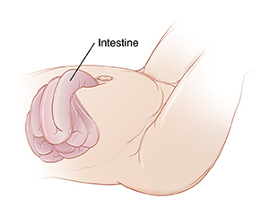 Baby's abdomen showing bowel coming through opening in belly wall near navel.