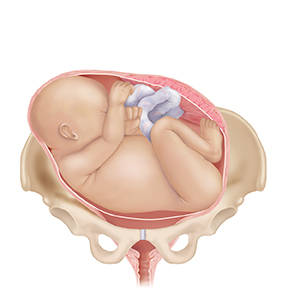 Front view of full-term fetus in uterus between pelvic bones with fetus' body lying sideways over birth canal, showing transverse position.