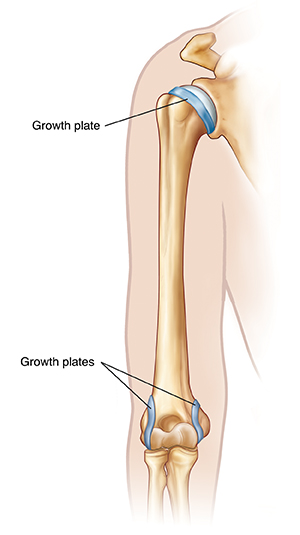 Front view of upper arm showing bones and growth plates.